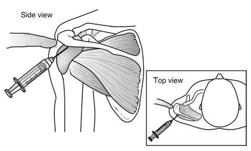 SubacromialBursaInjection
